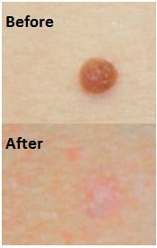 Mole Removal, Healthy Skin Centre