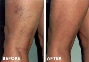 Sclerotherapy Before After Treatment