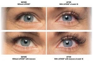 Latisse Eyes Before and After