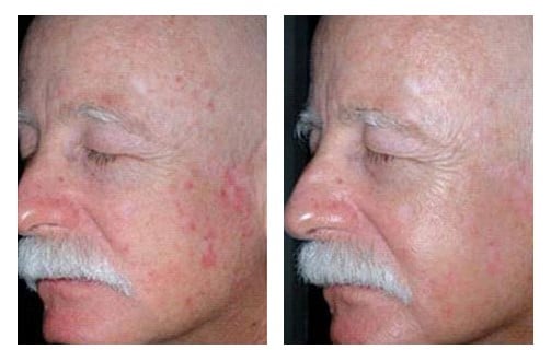 Photodynamic Therapy Before and After