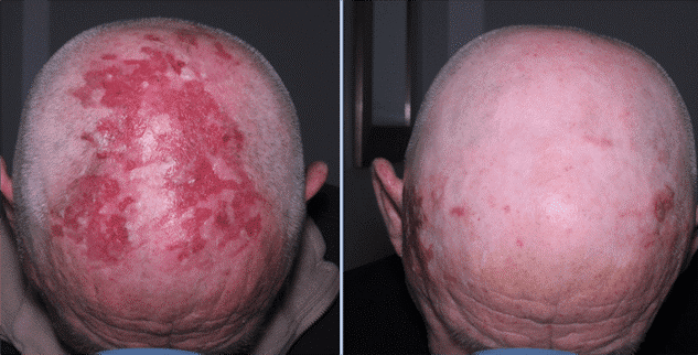 Photodynamic Therapy Before and After