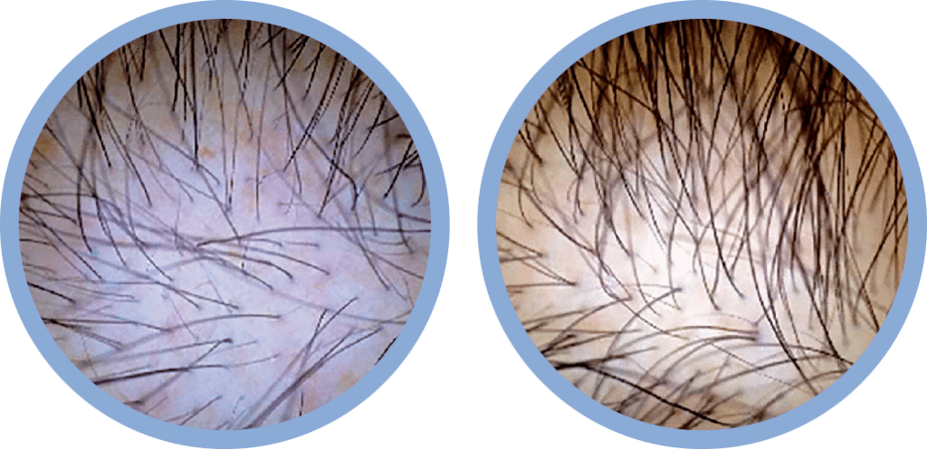 Platelet Rich Plasma, PRP, Before and After, Healthy Skin Centre