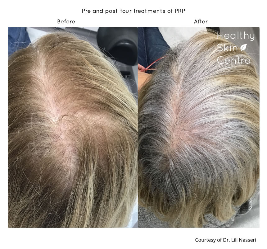 Hair Loss Treatment Service New Westminster | PRP | Healthy Skin Centre Hair Loss Treatment Service New Westminster | PRP | Healthy Skin Centre