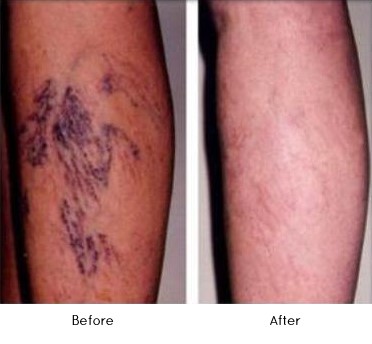 Spider Vein Treatment Before and After, Healthy Skin Centre