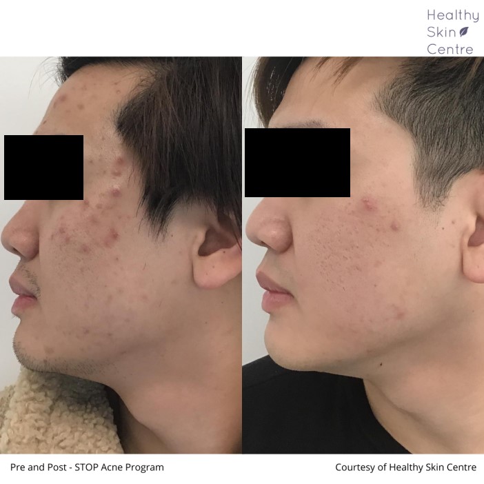 Stop_ACNE - Healthy Skin Centre