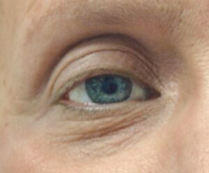 Lumiere Before - Healthy Skin Centre