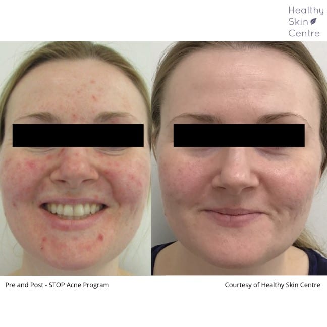Stop Acne Female 1, Healthy Skin Centre
