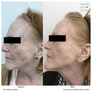 Skin Rejuvenation, Healthy Skin Centre