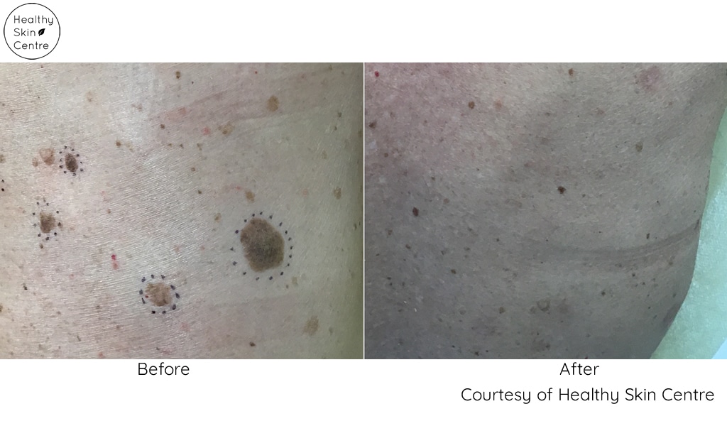 Before and After Mole Removal, Healthy Skin Centre