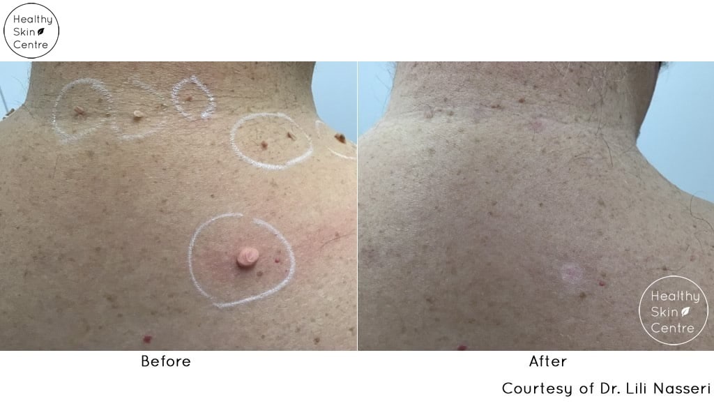 Before and After Mole Removal, Healthy Skin Centre