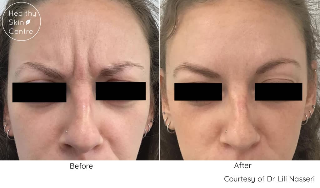 Before and After Botox_Xeomin Treatment, Healthy Skin Centre