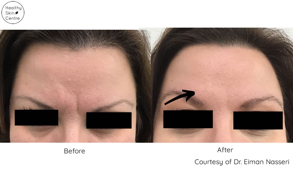 Before and After Botox_Xeomin Treatment, Healthy Skin Centre