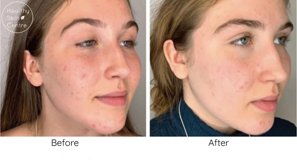 Advanced Clear Facial, Healthy Skin Centre
