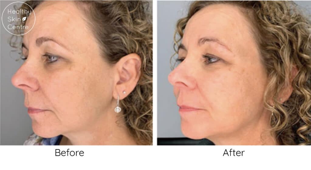 Advanced Glow Facial, Healthy Skin Centre