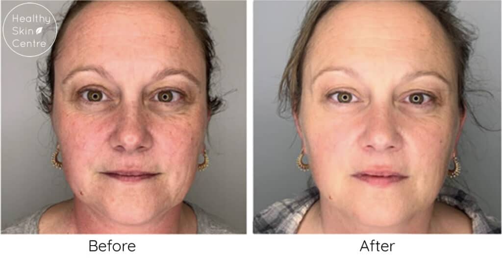 Advanced Glow Facial, Healthy Skin Centre