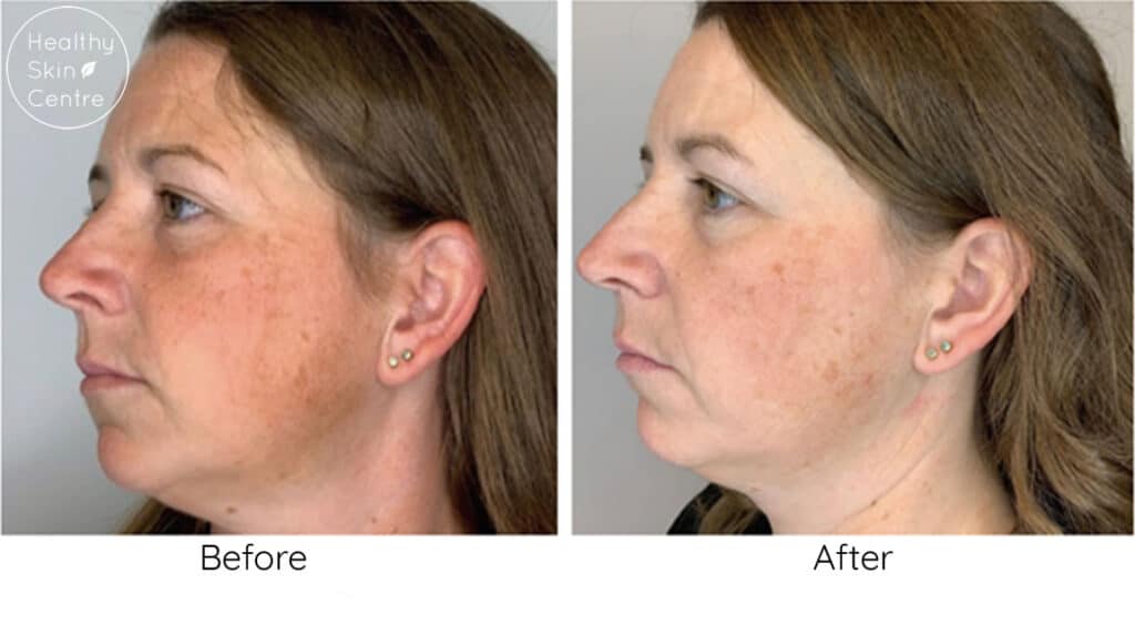 Advanced Pigment Facial, Healthy Skin Centre