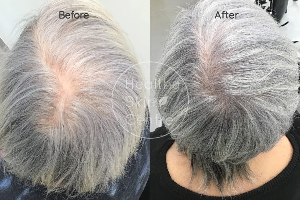 Pre and Post PRP Hair, Platelet Rich Plasma, Healthy Skin Centre