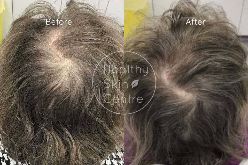 Pre and Post PRP Hair, Platelet Rich Plasma, Healthy Skin Centre
