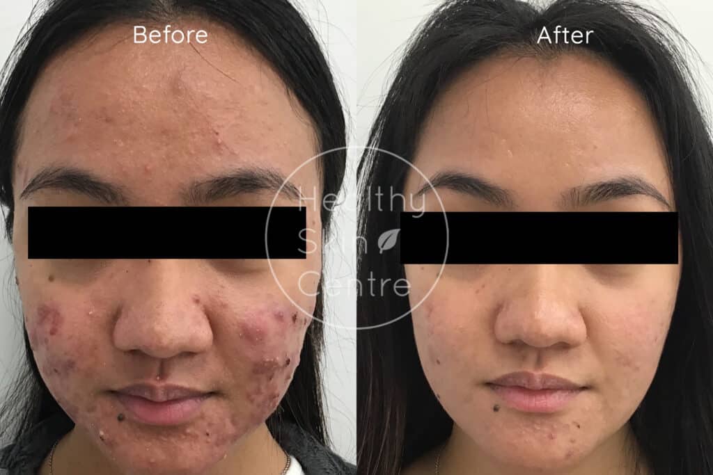 Pre and Post Help Pigment Program, Healthy Skin Centre