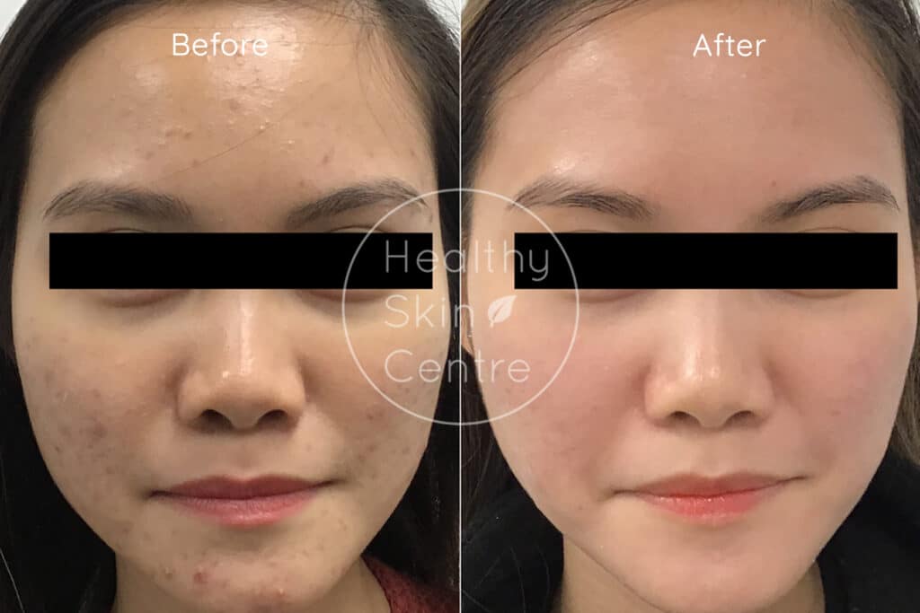 Pre and Post Help Pigment Program, Healthy Skin Centre