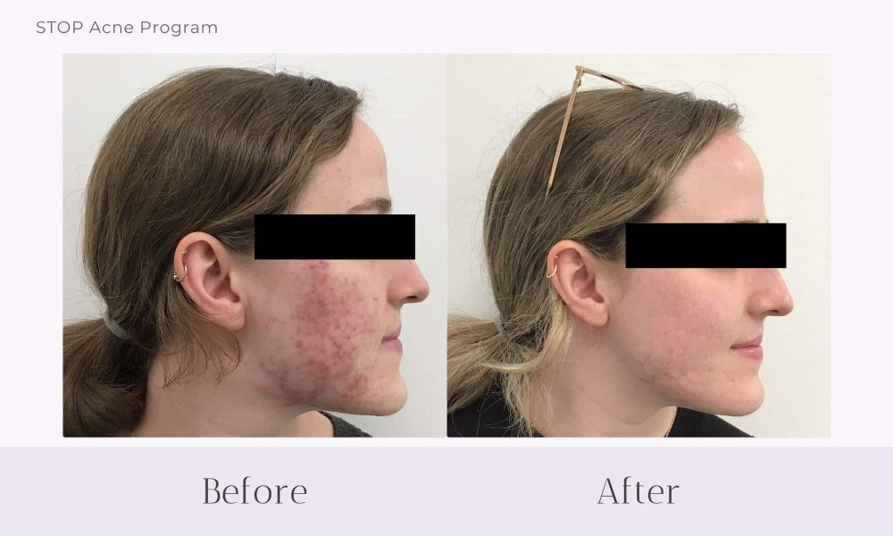 Before and after Acne treatment on face at Healthy Skin Centre